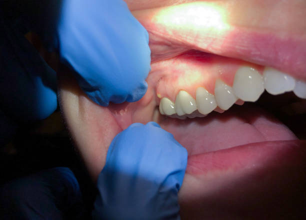 Best Emergency Treatment for Toothache in Mooreland, OK